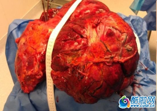 腹部去除了重达约23公斤的巨型肿瘤